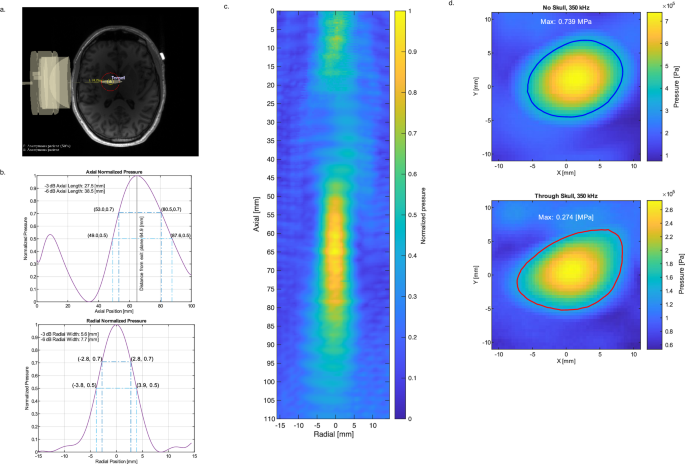 Transcranial ultrasound stimulation of the right globus pallidus interna in schizophrenia: A randomized, sham-controlled pilot study