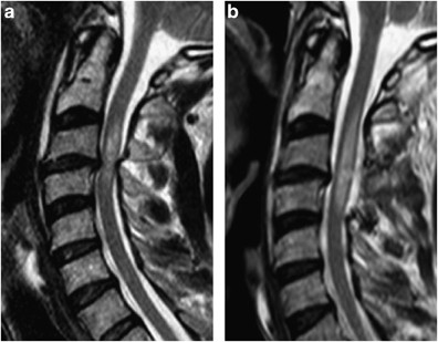 MRI in acute and subacute post-traumatic spinal cord injury: pictorial  review | Spinal Cord