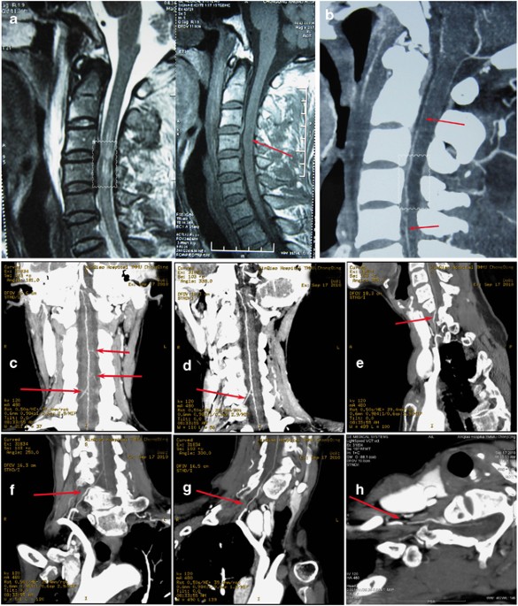 Computed tomographic angiography of anterior spinal artery in acute cervical spinal cord injury
