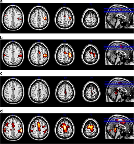 Functional mri of the cortical sensorimotor system in patients with hereditary spastic paraplegia