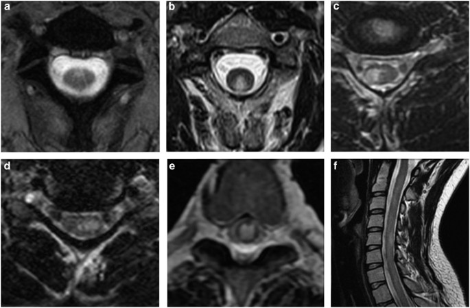 Thoracic spinal cord lesions are influenced by the degree of cervical spine  involvement in multiple sclerosis | Spinal Cord