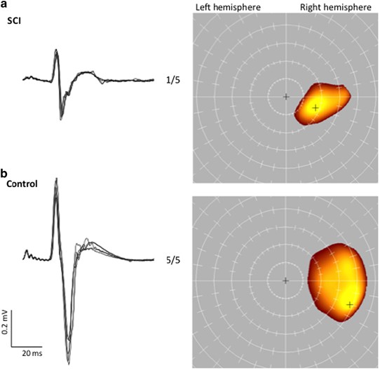 The corticomotor projection to liminally-contractable forearm muscles in chronic spinal cord injury: a transcranial magnetic stimulation study