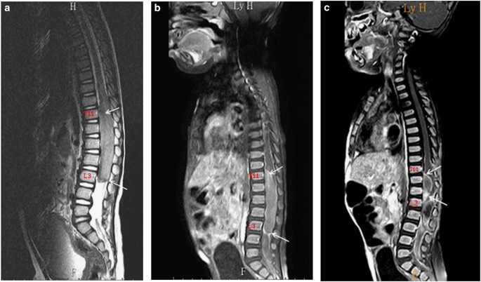 Atypical teratoid/rhabdoid tumor of lumbar spine in a toddler child | Spinal  Cord Series and Cases