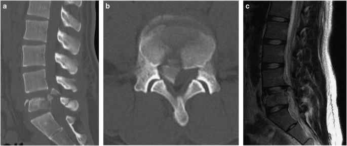 burst fracture burst fracture