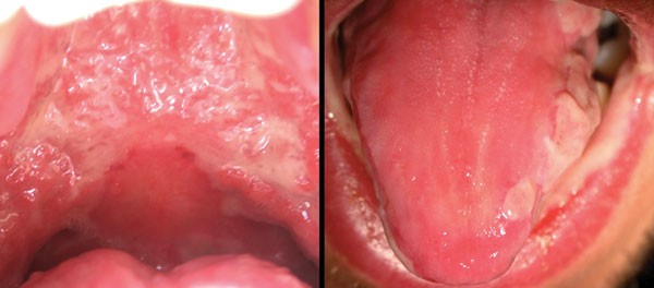 Traumatic Chemical Oral Ulceration A Case Report And Review Of The Literature British Dental Journal Traumatic Chemical Oral Ulceration A Case Report And Review Of The Literature British Dental Journal