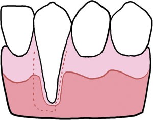 Gingival recession: part 2. Surgical management using pedicle grafts