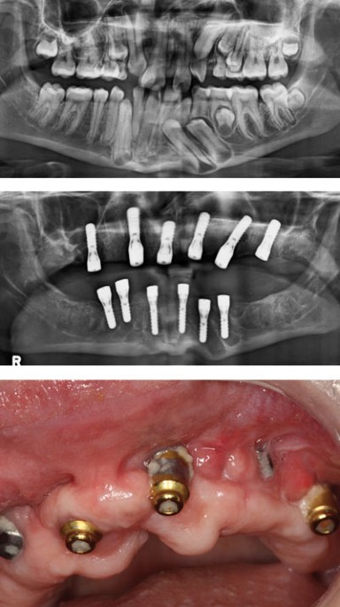 Peri-implantitis. Part 2: Prevention and maintenance of peri-implant health  | British Dental Journal