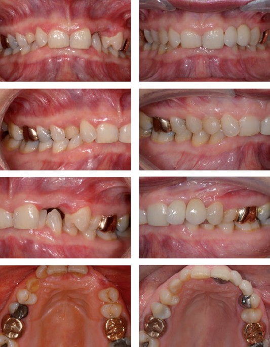 The restorative management of the deep overbite