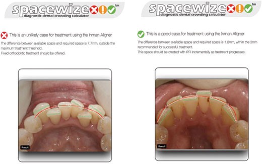 minor teeth alignment