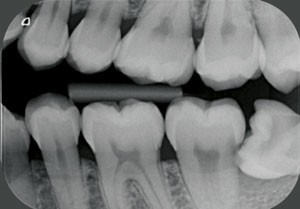 Distal Caries Of The Second Molar In The Presence Of A Mandibular Third Molar A Prevention Protocol British Dental Journal