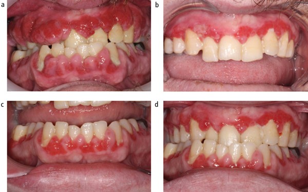 Gingival overgrowth: Part 2: management strategies | British Dental Journal