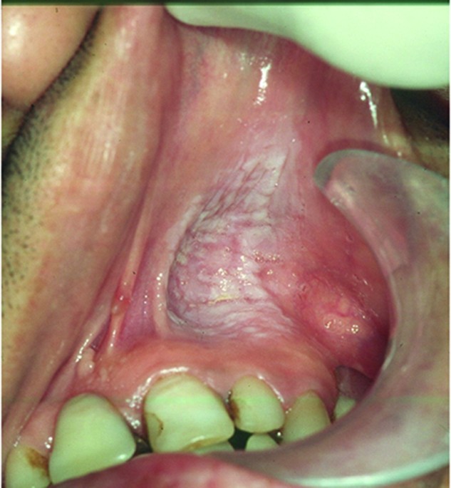 Oral cancer and tobacco: developments in harm reduction | British Dental  Journal