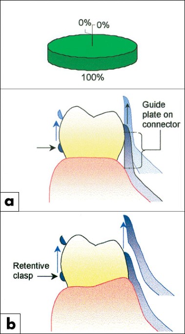Clasp Design British Dental Journal - 