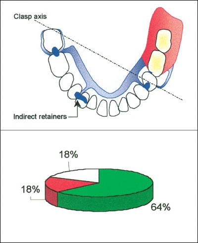 Clasp Design British Dental Journal - 