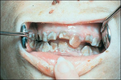 Tooth Discolouration And Staining A Review Of The Literature British Dental Journal Tooth Discolouration And Staining A Review Of The Literature British Dental Journal