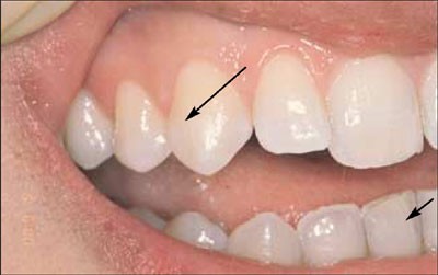 Incomplete tooth fracture – proposal for a new definition | British Dental  Journal