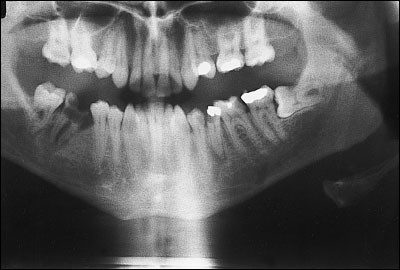 Mortality associated with odontogenic infection!