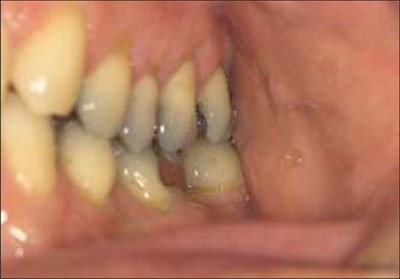 Good occlusal practice in simple restorative dentistry