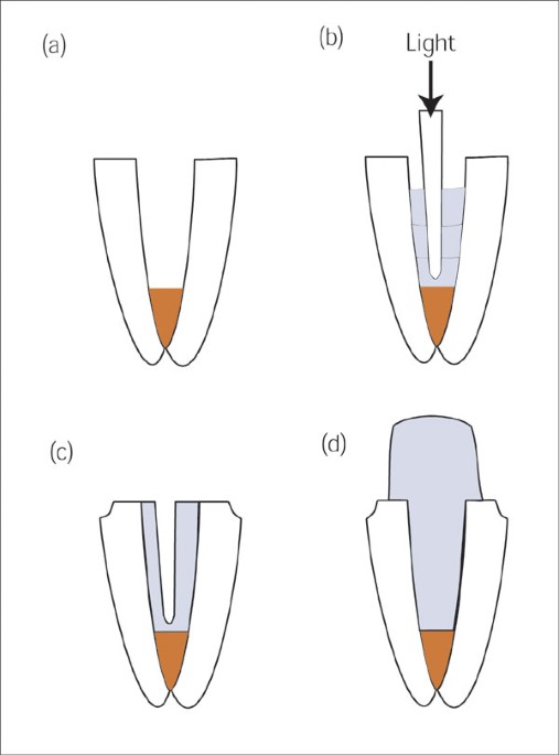 Crowns and extracoronal restorations Endodontic considerations the