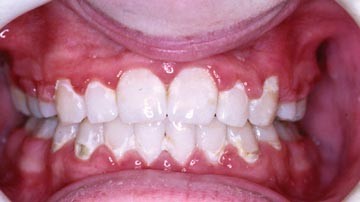 Orthodontics Part 6 Risks In Orthodontic Treatment British Dental Journal Orthodontics Part 6 Risks In Orthodontic Treatment British Dental Journal