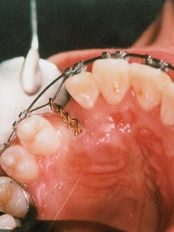 Orthodontics. Part 10: Impacted teeth | British Dental Journal