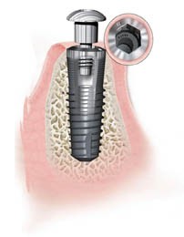New internal hex implant system | British Dental Journal
