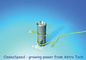 Astra Tech S Osseospeed British Dental Journal