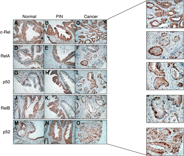 Nuclear Localisation Of Nuclear Factor Kappab Transcription Factors In Prostate Cancer An Immunohistochemical Study British Journal Of Cancer