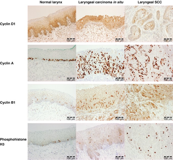 Immunohistochemical estimation of cell cycle phase in laryngeal neoplasia |  British Journal of Cancer