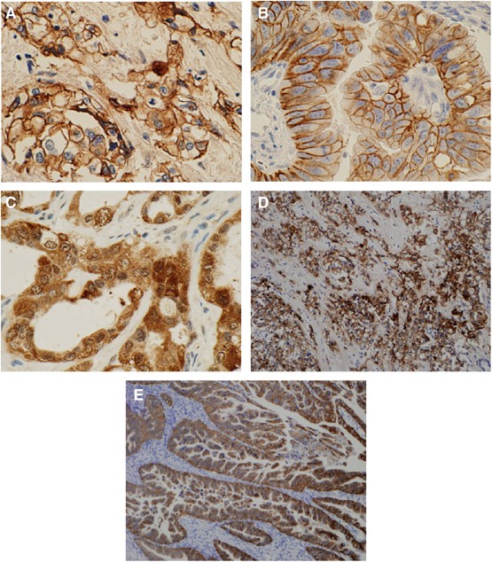 Clinicopathological and prognostic significance of egfr, vegf, and her2 expression in cholangiocarcinoma