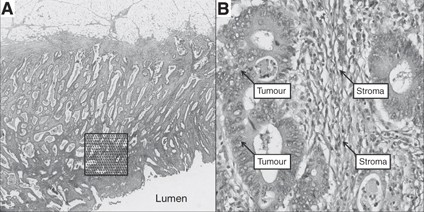 The proportion of tumour cells is an independent predictor for survival in colorectal cancer patients