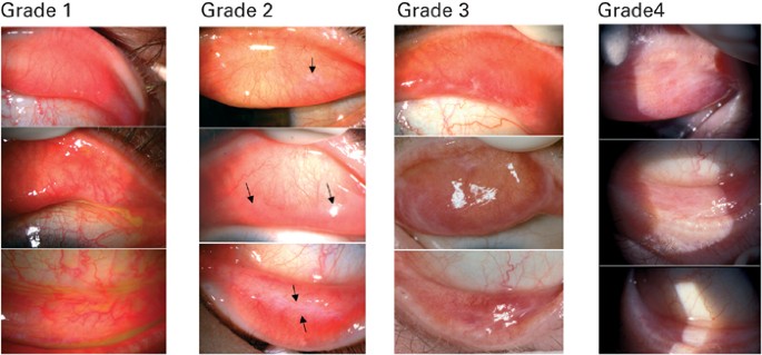 Topical corticosteroid therapy for cicatricial conjunctivitis associated with chronic graft-versus-host disease