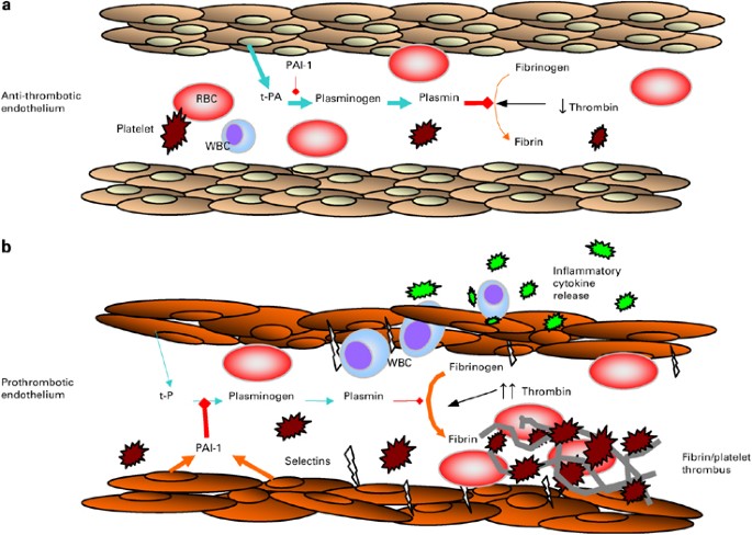 Pulmonary veno-occlusive disease following hematopoietic stem cell transplantation: a rare model of endothelial dysfunction