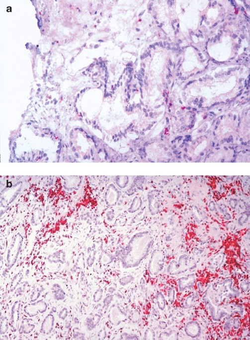 A phase I trial of adenovector-mediated delivery of interleukin-2 (AdIL-2) in high-risk localized prostate cancer