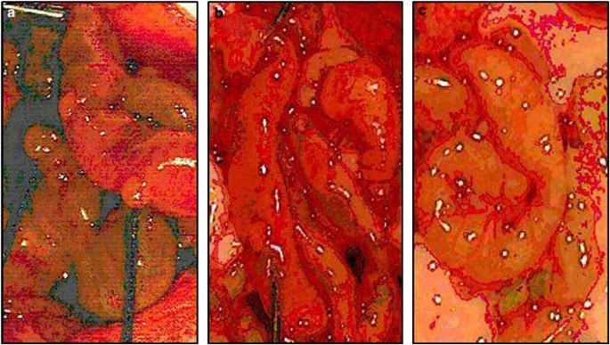 peritoneal cancer and immunotherapy)