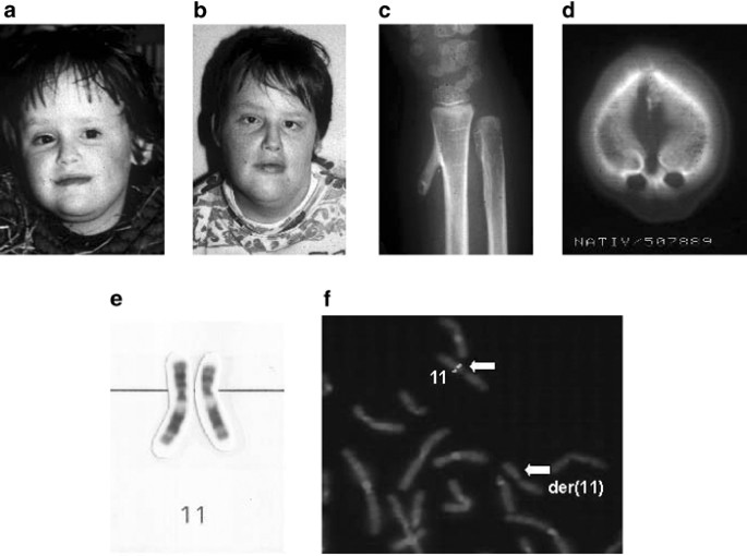 Proximal 11p deletion syndrome (P11pDS): additional