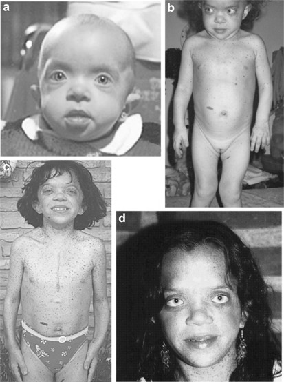 Noonan syndrome, multiple lentigines/LEOPARD syndrome and Noonan-like/multi...