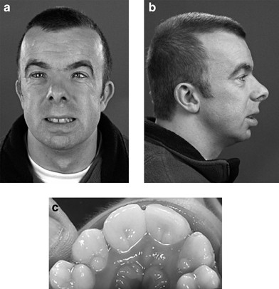 Rubinstein-Taybi Syndrome Images — DermNet