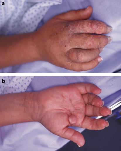 (PDF) Identification of de novo EP300 and PLAU variants in a patient with  Rubinstein–Taybi syndrome-related arterial vasculopathy and skeletal anomaly