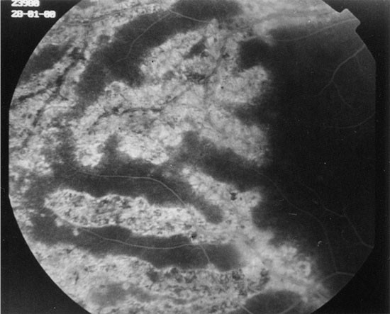 Inflammatory pigmented paravenous retinochoroidal atrophy