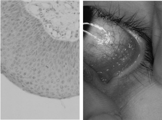 papillomatosis interferon treatment)