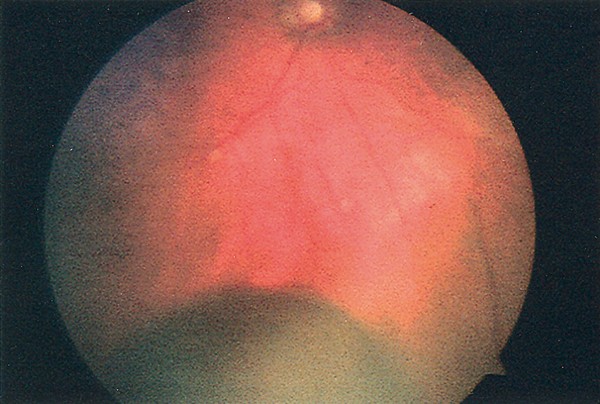 Spontaneous suprachoroidal haemorrhage following a valsalva manoeuvre