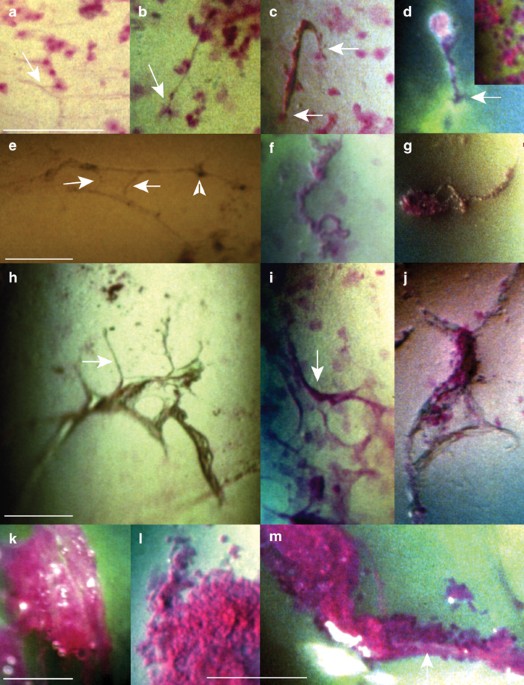 Corneal surface changes in keratoconjunctivitis sicca. Part ii: the mucus component. A non-contact photomicrographic in vivo study in the human cornea