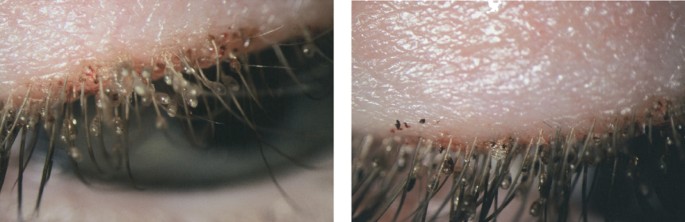 pubic lice treatment