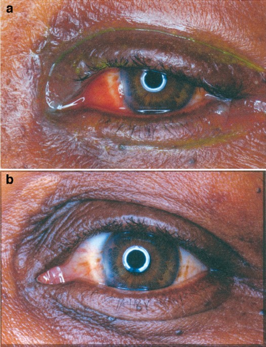 oedema eye symptoms