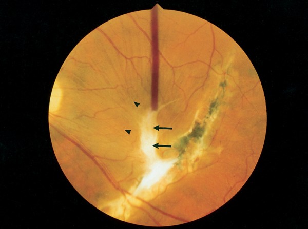 Surgical removal of sequential epiretinal and subretinal neovascular membranes in a patient with traumatic choroidal rupture