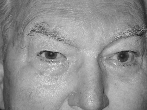 Aberrant facial nerve regeneration (afr): an under-recognized cause of ptosis