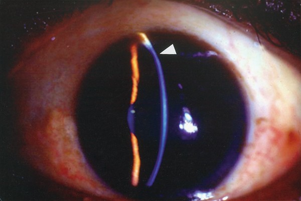 Superior pellucid marginal corneal degeneration