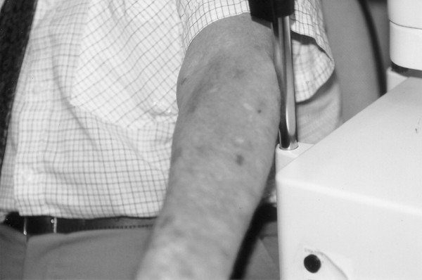 Fluorescein angiography and patchy skin discoloration: a case report