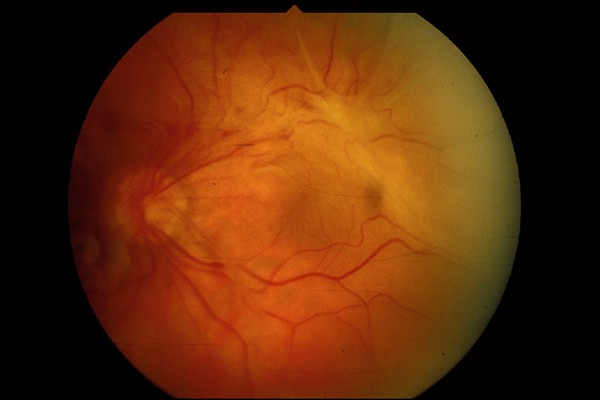 Radiation retinopathy secondary to radiotherapy for a lower lid bcc